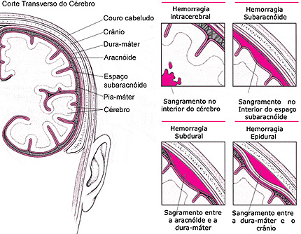 Hemorragia Cerebral