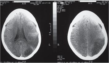 Isquemia Cerebral