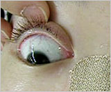 bobbing ocular
