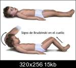 Sinal de Brudzinsk