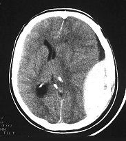 epidural